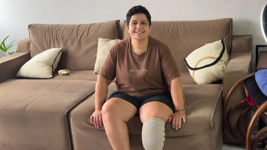 Moradora de Criciúma faz campanha solidária para custear prótese após amputação